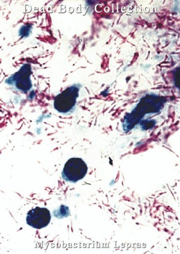 Mycobacterium Leprae